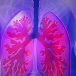 Lungenembolie - Ursachen, Symptomen und Behandlung