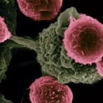 Prostatakrebs im Frühstadium kann aggressive Tumorzellen beinhalten