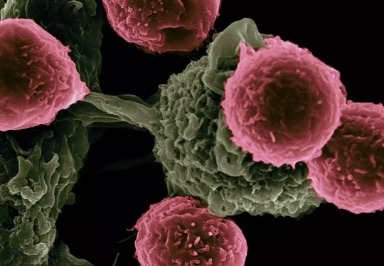 Prostatakrebs: Forscher entdecken Ursache für Metastasenbildung