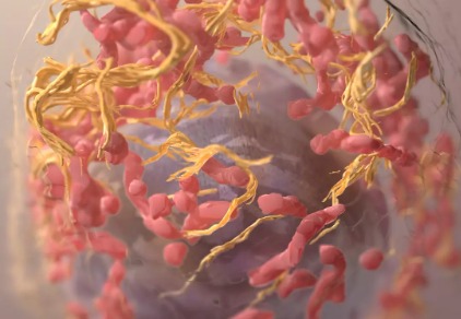 Forscher zeigen auf wie Bauchspeicheldrüsenkrebs entsteht