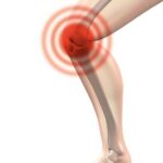 Knieschmerzen was hilft? Genicularnerv-Radiofrequenz-Ablation reduziert Knieschmerzen erheblich