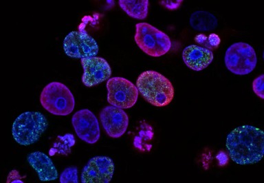 Darmkrebs: Neuer Biomarker könnte die Ausbreitung verlangsamen