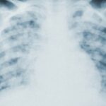 Wie sich eine Art von Lungenkrebs in eine andere verwandeln kann