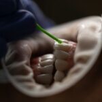 Abgebrochener Zahn - Ursachen, Behandlung und Hilfe