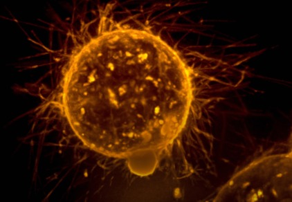 Krebs-Forscher entwickeln Frühdiagnose für Metastasenbildung