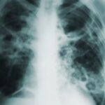 Neue Klassifizierung für Tuberkulose gefunden