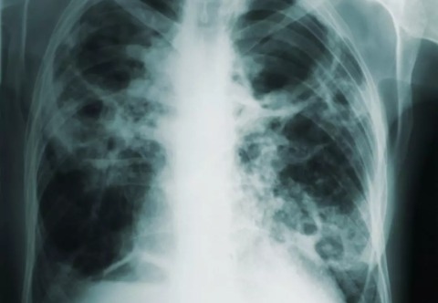 Neue Klassifizierung für Tuberkulose gefunden