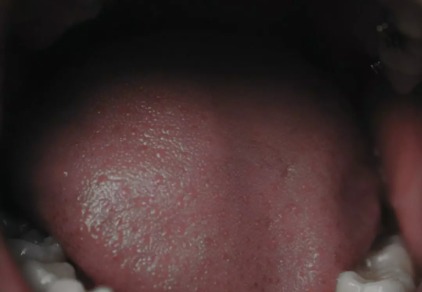 Bläschen auf der Zunge: Ursachen und Behandlung