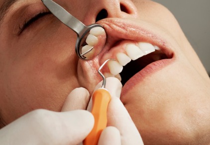 Amalgam: Wie schädlich ist die Zahnfüllung?