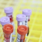 Durchbruch bei Alzheimer-Bluttests