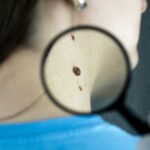Thermografie erkennt Melanome, bevor sie sichtbar werden
