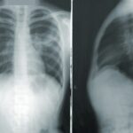 Vererbte EGFR-Variante T790M und Lungenkrebs bei Nichtrauchern Genetik, Häufigkeit und Herkunft